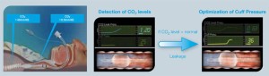 AnapnoGuard -  Keeps Endotracheal Tube Cuffs at Right Pressure