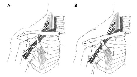 View of Postural cues for scapular retraction and depression promote  costoclavicular space compression and thoracic outlet syndrome